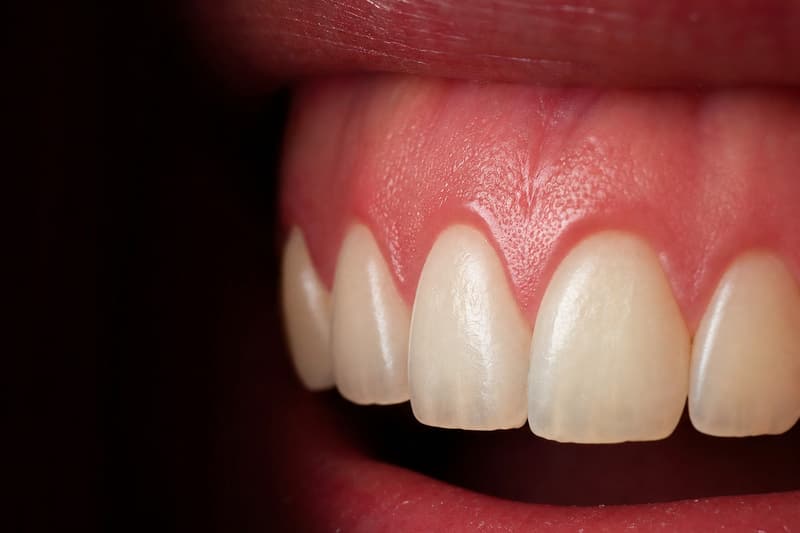 Sorriso com uma faixa larga de gengiva aparente acima dos dentes superiores